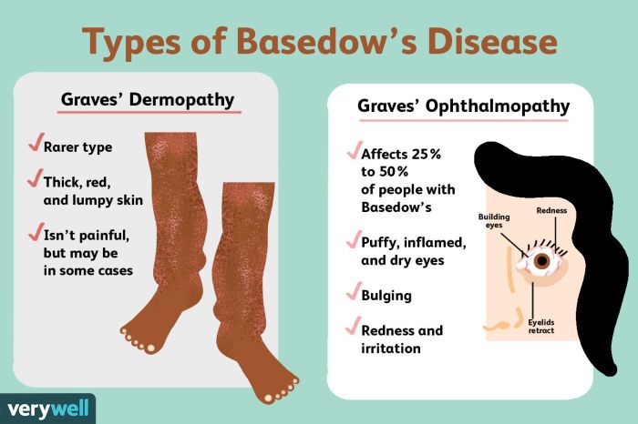 Basedow und ernährung ernährungs docs